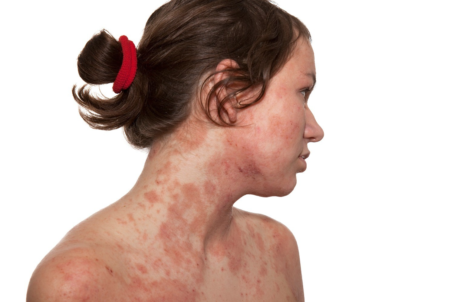 Temperaturas frias podem intensificar sintomas da dermatite atópica