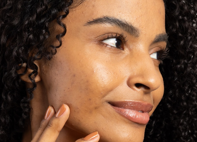 Os efeitos da acne e como melhorar a autoestima